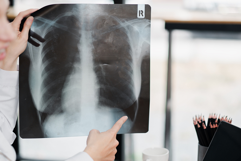 Close-up of a medical professional pointing at a chest X-ray image, highlighting diagnostic details in a modern clinic environment.